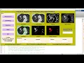 Matlab code for Lung Cancer Detection and Classification using Image Processing