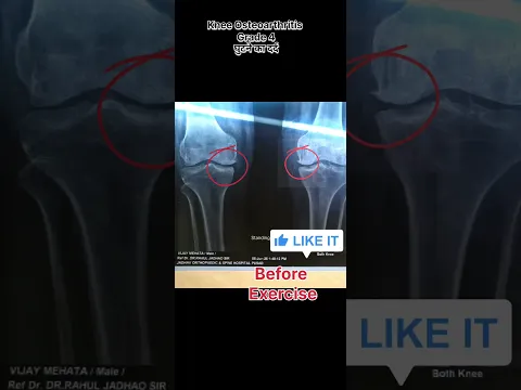 Osteoarthritis grade 4 treatment #ghutnekadard #kneeexercise #KneePain #kneeosteoarthritis