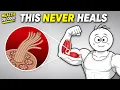 Your Tendons Will Never Heal Unless You Do This strong curiosity gap implies urgency