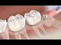 Wisdom Teeth Removal in Amarillo TX Amarillo Oral Maxillofacial Surgery