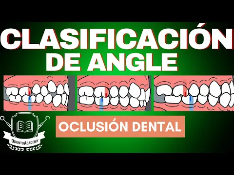 Download MP3 CLASIFICACIÓN DE LAS MALOCLUSIONES | CLASIFICACIÓN DE ANGLE | oclusión dental.
