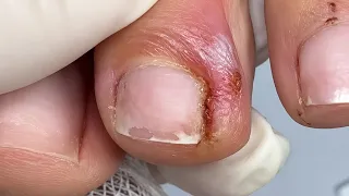 O problema não era só a unha, veja o que ocasionou essa unha encravada #nails #satisfying