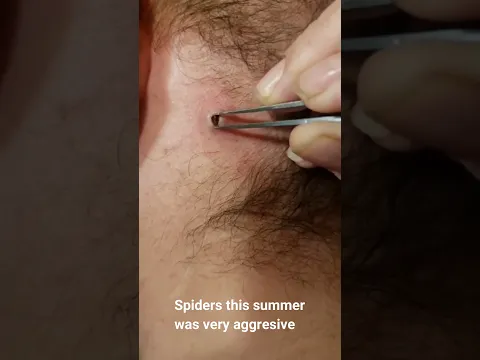 Spiders this summer was very aggresive