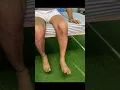 Download Lagu Rom exercises post surgery of tibial condyle part -1 #nopainnogain #physiotherapy #recovery #rom
