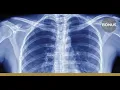 Cant Miss X-rays in Urgent Care Part 1 Chest X-ray - A Frank Discussion MC CME Podcast
