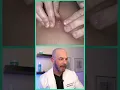 Download Lagu Derm reacts to SHOOTING abscess! #dermreacts #doctorreacts #abcess #pimplepop