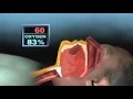Dental Smiles of Willow Glen Presents What is OSA