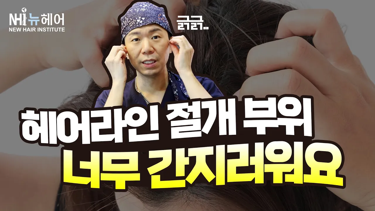 헤어라인 모발이식 1개월, 절개 부위 너무 가려워요ㅣ뉴헤어