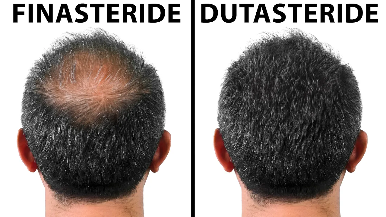 Which Is The Best Medication For Hair Loss: Finasteride or Dutasteride?