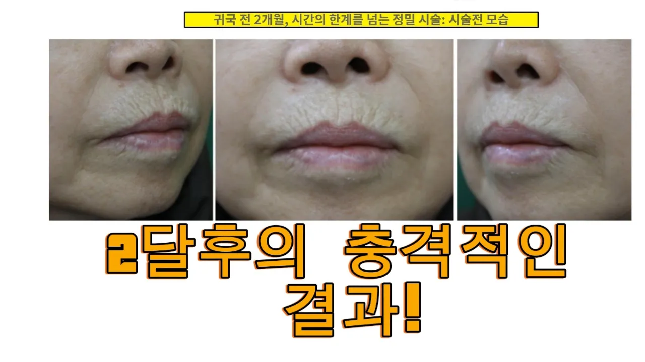 15년 한국생활의 마침표! 입술 고양이주름 해결하고 고향으로! #기계적박피 #주름성형#중국동포#효도성형