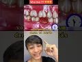 Download Lagu Essas são as Consequências de Perder um Dente Detrás. Em 16 Segundos!! #shorts