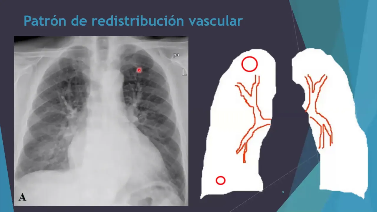 Patrones vasculares pulmonares PARTE I