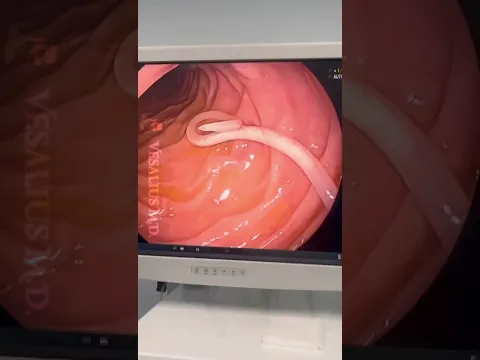 Parásito INTESTINAL