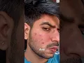 Download Lagu Best Face wash For Acne \u0026 Pimples 😲 #shorts #acne #pimples #facewash #skincare