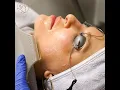 Forever Young IPL Photofacial at Revive