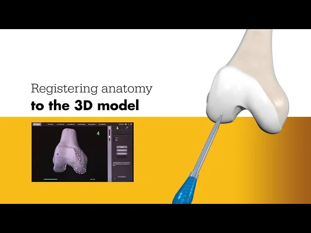 Mako Robotic Total and Partial Knee Replacement | El Camino Health