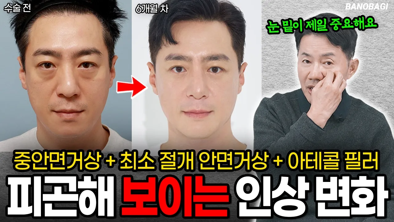 눈 밑 다크서클로 늙어 보이던 중년 남성💀 중안면거상+최소 절개 위캔안면거상+아테콜필러 받고 30대로 회춘💛