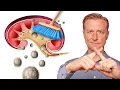 Clean Out Your Kidneys of Oxalates and Stones - Dr Berg