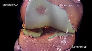 stages of knee osteoarthritis