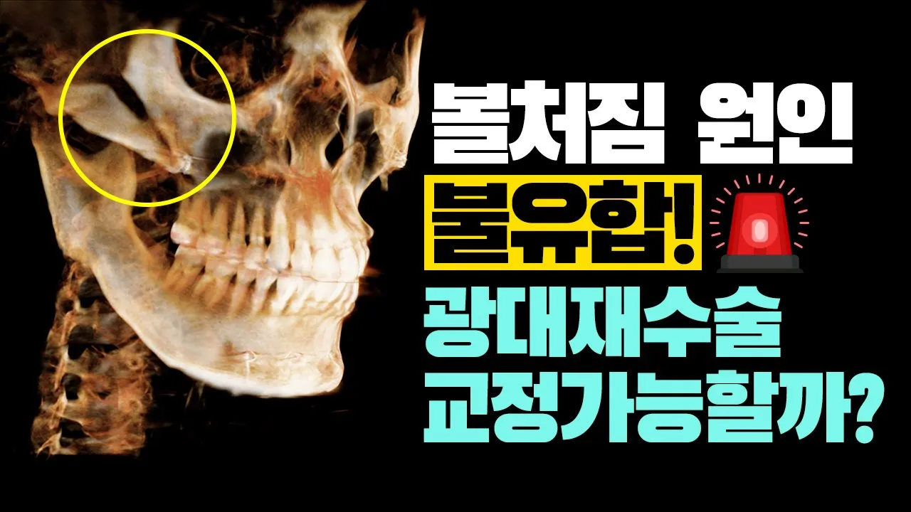 광대수술 후 볼처짐이 생기는 원인과 재수술을 통한 교정방법