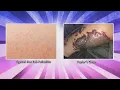 What Puts You at Risk for Hot Tub Folliculitis