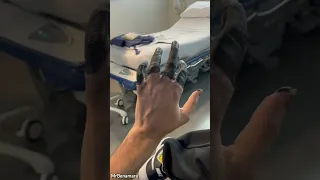 لماذا هذه اليد تحتوي على أصابع سوداء السبب سيصدمك قصة Shorts حقائق 