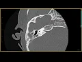 Down Syndrome Aperture Stenosis - Inner Ear MRI