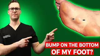bump on the bottom of my foot plantar fibroma treatment u0026 massage