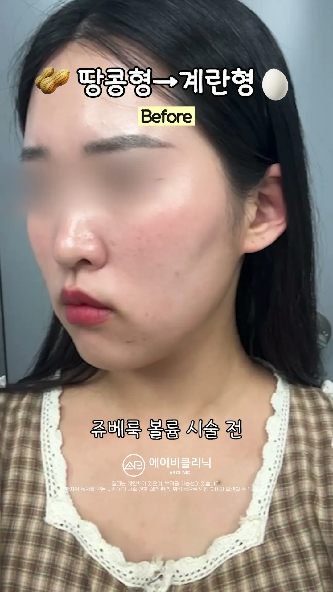 땅콩형 얼굴 시술