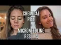 I DID A CHEMICAL PEEL MICRONEEDLING
