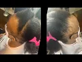 NO EDGES ALOPECIA YOU CAN STILL GET BRAIDS KNOTLESS BRAIDS ON FRONTAL EVE HAIR