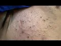 Download Lagu Deep Cleansing Techniques For Acne — Severe Acne Removal