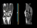 Download Lagu DISI and SLAC wrist, scapholunate ligament tear, and tenosynovitis