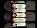 5 Nail Changes You Should NEVER Ignore Nail signs of Disease