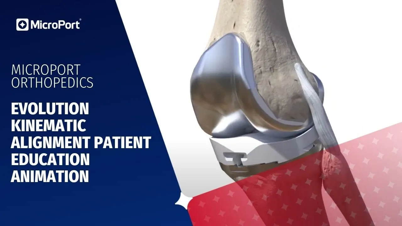 MicroPort 3D medical MoA video