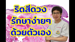 ริดสีดวงทวารคืออะไร และมีกี่ชนิด