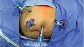 pyelotomy cpt code simplify medical coding
