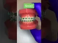 Best braces colors for red hair
