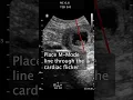 Download Lagu How to Measure a Fetal Heart Rate in the 1st Trimester #POCUS #Ultrasound  #emergencymedicine #OBGYN