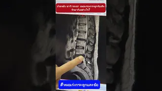  อาการปวดหลังร้าวลงขาเกิดจากสาเหตุอะไร 