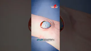 الطريقة الصحيحة لإزالة الكيس الدهني من جسمك 