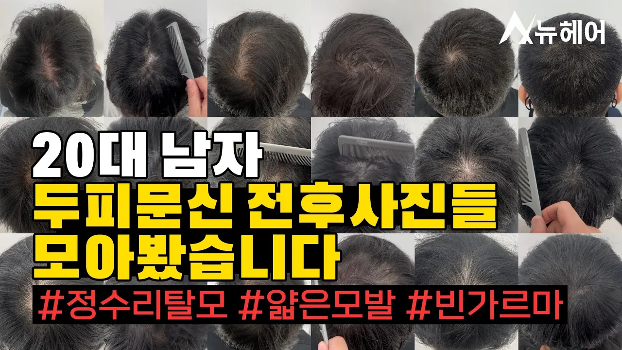 20대 남자 두피문신 전후사진 1탄 (정수리탈모,얇은모발,빈가르마 모여라)