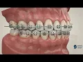 How Do Braces Fix an Overbite 3D Animation Explains the Process
