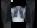 Download Lagu Normal lung vs Infected lungs 🫁 #lungs #chest #radiology #xray #neet #radiology #medicos #doctor