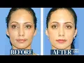 Facial Fat Transfer Results 9 Years Later Fat Transfer to cheeks under eyes and temples