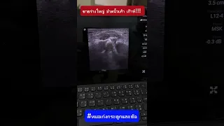  ทำไมการรักษาโรคเกาต์จึงต้องตรวจเลือดและปัสสาวะเป็นประจำ 