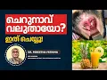 Uvulitis Causes Treatment Explained