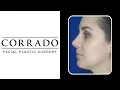 Dorsal Hump and Bulbous Tip Rhinoplasty Before After Pictures Dr Anthony Corrado