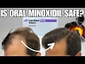 How Safe is Oral Minoxidil Dr Sergio Vano Answers