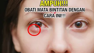 Download AMPUH! 7 Cara EFEKTIF Hilangkan Mata Bintitan. ALAMI TANPA OBAT. MP3